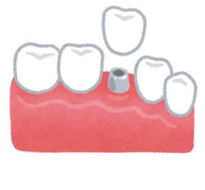 teeth_implant