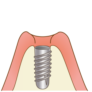 implant003