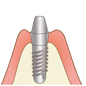implant005